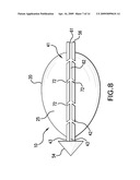 METHODS OF STABILIZING THE SACROILIAC JOINT diagram and image