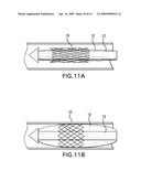 METHODS OF STABILIZING THE SACROILIAC JOINT diagram and image