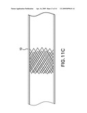 METHODS OF STABILIZING THE SACROILIAC JOINT diagram and image