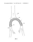 WOVEN INTRAVASCULAR DEVICES AND METHODS FOR MAKING THE SAME diagram and image