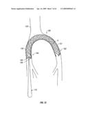 WOVEN INTRAVASCULAR DEVICES AND METHODS FOR MAKING THE SAME diagram and image