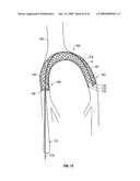 WOVEN INTRAVASCULAR DEVICES AND METHODS FOR MAKING THE SAME diagram and image