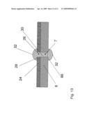 COVERED STENT diagram and image