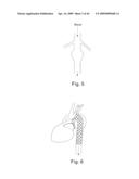 Modular stent graft and delivery system diagram and image