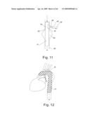 Modular stent graft and delivery system diagram and image