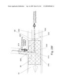 Modular stent graft and delivery system diagram and image