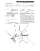 Spongy implant diagram and image