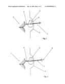 Spongy implant diagram and image