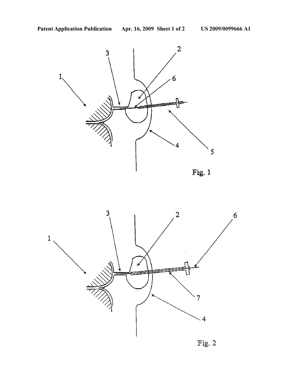 Spongy implant - diagram, schematic, and image 02