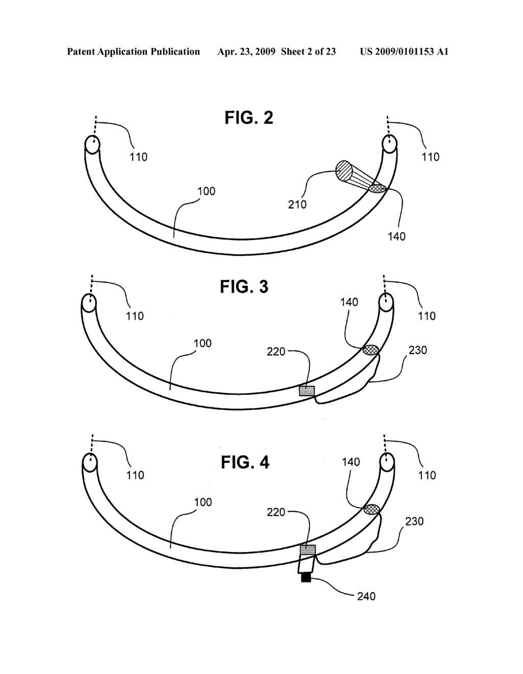 Method of facilitated airway intubation - diagram, schematic, and image 03