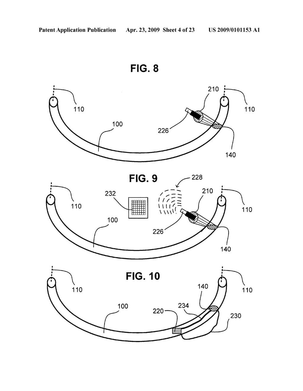 Method of facilitated airway intubation - diagram, schematic, and image 05