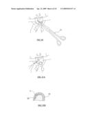 Bioresorbable Inflatable Devices, Incision Tool And Methods For Tissue Expansion And Tissue Regeneration diagram and image