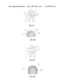 Bioresorbable Inflatable Devices, Incision Tool And Methods For Tissue Expansion And Tissue Regeneration diagram and image