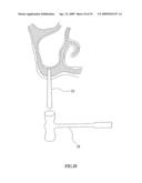 Bioresorbable Inflatable Devices, Incision Tool And Methods For Tissue Expansion And Tissue Regeneration diagram and image