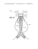  LOCAL ADMINISTRATION OF A COMBINATION OF RAPAMYCIN AND PANZEM FOR THE TREATMENT OF VULNERABLE PLAQUE diagram and image