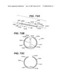  LOCAL ADMINISTRATION OF A COMBINATION OF RAPAMYCIN AND PANZEM FOR THE TREATMENT OF VULNERABLE PLAQUE diagram and image