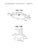  LOCAL ADMINISTRATION OF A COMBINATION OF RAPAMYCIN AND PANZEM FOR THE TREATMENT OF VULNERABLE PLAQUE diagram and image