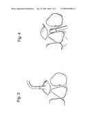 Collagen Antral Membrane Expander diagram and image