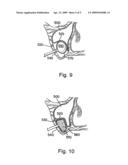 Collagen Antral Membrane Expander diagram and image