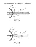 METHOD OF TREATING BENIGN HYPERTROPHY OF THE PROSTATE diagram and image