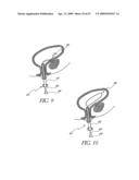 METHOD OF TREATING BENIGN HYPERTROPHY OF THE PROSTATE diagram and image