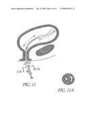 METHOD OF TREATING BENIGN HYPERTROPHY OF THE PROSTATE diagram and image