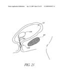 METHOD OF TREATING BENIGN HYPERTROPHY OF THE PROSTATE diagram and image