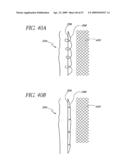 METHOD OF TREATING BENIGN HYPERTROPHY OF THE PROSTATE diagram and image