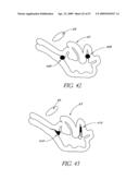 METHOD OF TREATING BENIGN HYPERTROPHY OF THE PROSTATE diagram and image