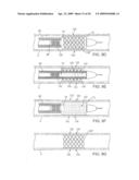 ADJUSTABLE-LENGTH DRUG DELIVERY BALLOON diagram and image