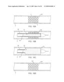 ADJUSTABLE-LENGTH DRUG DELIVERY BALLOON diagram and image