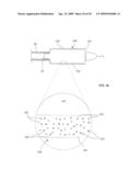 ADJUSTABLE-LENGTH DRUG DELIVERY BALLOON diagram and image