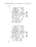 Cam-locking of cable for fracture plate diagram and image