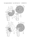 Mechanical apparatus and method for delivering materials into the inter-vertebral body space for nucleus replacement diagram and image