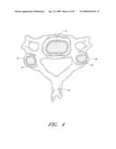 METHODS, SYSTEMS AND APPARATUSES FOR TORSIONAL STABILIZATION diagram and image