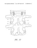 METHODS, SYSTEMS AND APPARATUSES FOR TORSIONAL STABILIZATION diagram and image