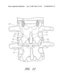 METHODS, SYSTEMS AND APPARATUSES FOR TORSIONAL STABILIZATION diagram and image