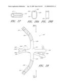 METHODS, SYSTEMS AND APPARATUSES FOR TORSIONAL STABILIZATION diagram and image