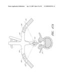 METHODS, SYSTEMS AND APPARATUSES FOR TORSIONAL STABILIZATION diagram and image