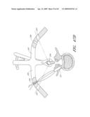 METHODS, SYSTEMS AND APPARATUSES FOR TORSIONAL STABILIZATION diagram and image