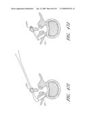 METHODS, SYSTEMS AND APPARATUSES FOR TORSIONAL STABILIZATION diagram and image