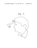 LONG-TERM SPG STIMULATION THERAPY FOR PREVENTION OF VASCULAR DEMENTIA diagram and image