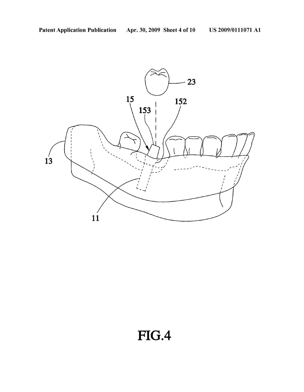 Method for designing a digital abutment for dental implant - diagram, schematic, and image 05