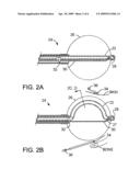 Brachytherapy Apparatus and Method Using Rotating Radiation Source diagram and image