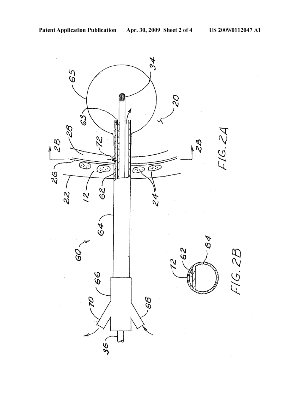 Brachytherapy apparatus and method for use with minimally invasive surgeries of the lung - diagram, schematic, and image 03