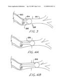Brachytherapy apparatus and method for use with minimally invasive surgeries of the lung diagram and image