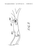 Brachytherapy apparatus and method for use with minimally invasive surgeries of the lung diagram and image