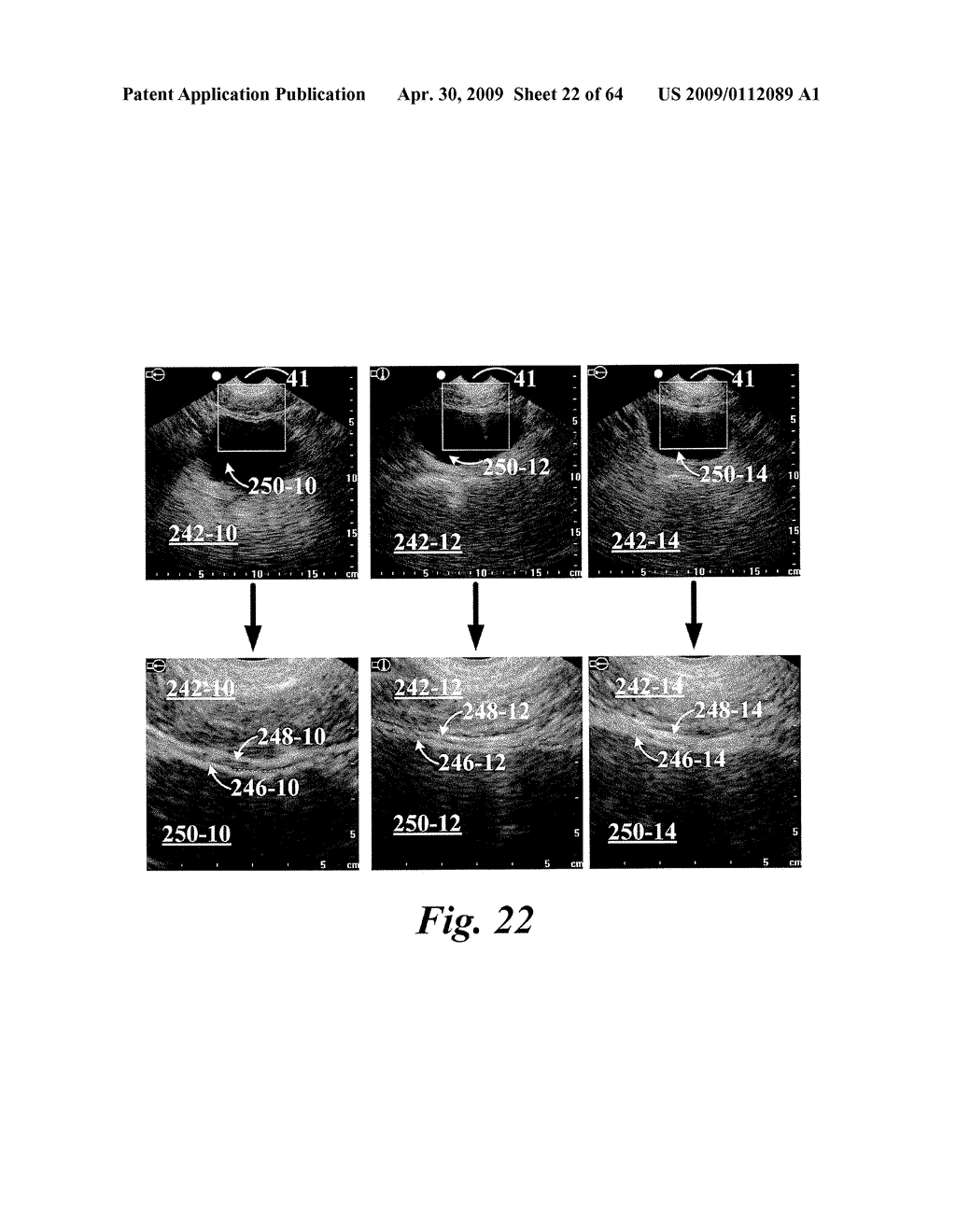 SYSTEM AND METHOD FOR MEASURING BLADDER WALL THICKNESS AND PRESENTING A BLADDER VIRTUAL IMAGE - diagram, schematic, and image 23