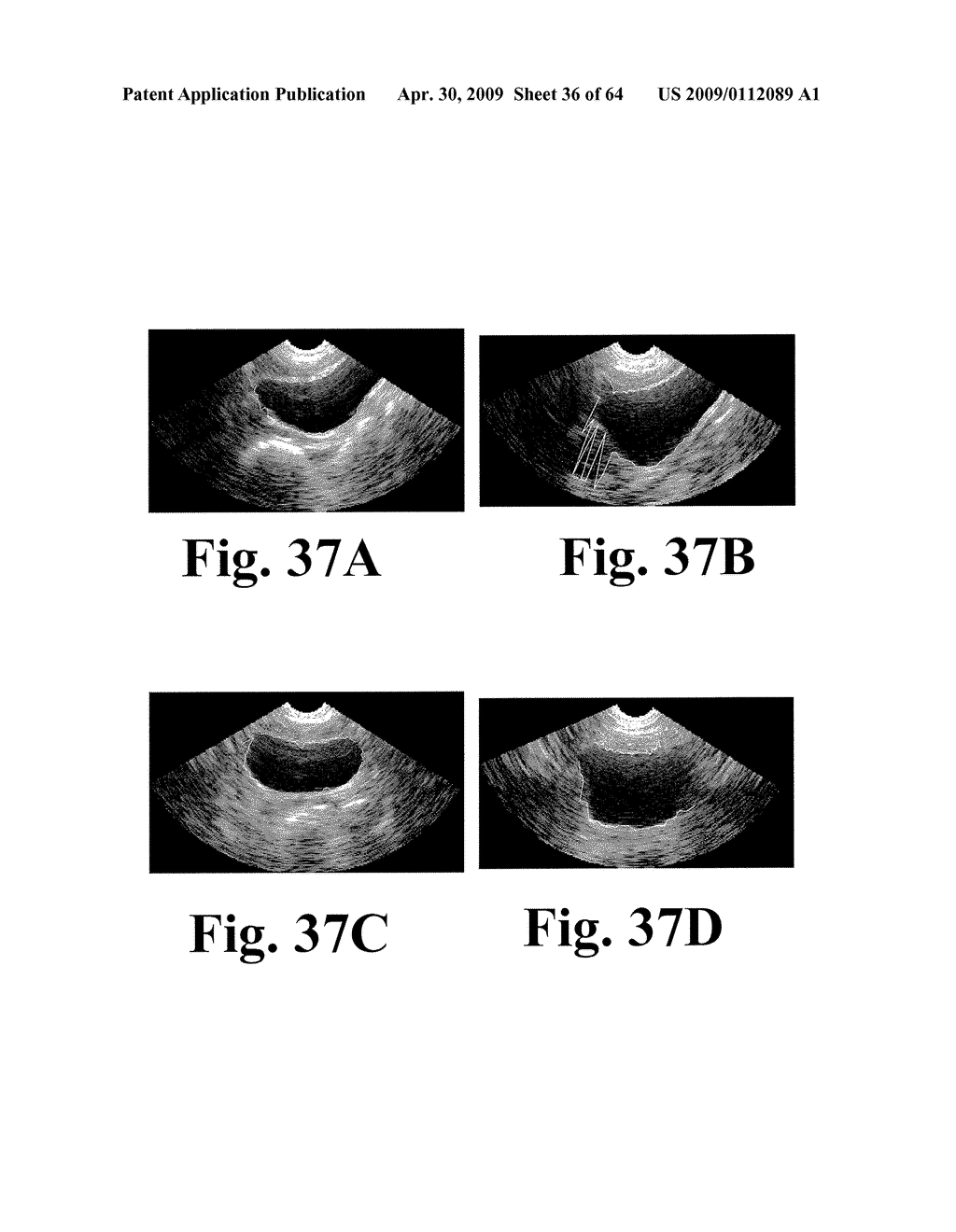 SYSTEM AND METHOD FOR MEASURING BLADDER WALL THICKNESS AND PRESENTING A BLADDER VIRTUAL IMAGE - diagram, schematic, and image 37