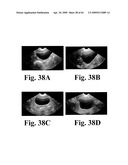 SYSTEM AND METHOD FOR MEASURING BLADDER WALL THICKNESS AND PRESENTING A BLADDER VIRTUAL IMAGE diagram and image